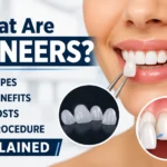 what are veneers?
