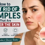 How to Get Rid of Pimples That Are Under the Skin